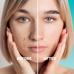 Microdarts Patches Targeted Blemish & Skin Support with Hyaluronic Acid, Salicylic Acid & Niacinamide
